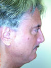 Facelift NYC