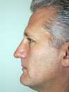 NYC Rhinoplasty
