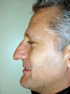 NYC Rhinoplasty