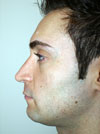 Nose Job NYC