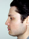 NYC Rhinoplasty before after