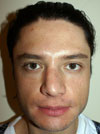 Nose Job NYC