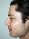 NYC Rhinoplasty before after
