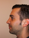 NYC Rhinoplasty
