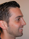 NYC Rhinoplasty before after