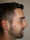 NYC Rhinoplasty before after