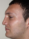 Rhinoplasty in NYC