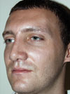 Rhinoplasty NYC