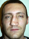 Rhinoplasty in NYC
