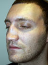 Rhinoplasty NYC