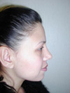 Nose Job New York