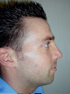 Rhinoplasty NYC before after