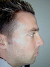 Rhinoplasty NYC before after