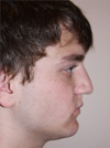 Rhinoplasty in NYC