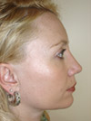 Nose Job NYC