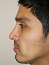 NYC Rhinoplasty