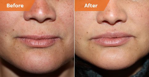 Woman's face, Before and After Lip Enhancement Treatment, lips, front view, patient 1