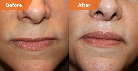 Woman's face, Before and After Lip Enhancement Treatment, lips, front view, patient 2