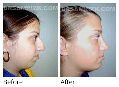 Woman's face, before and after Chin and cheek treatment, side view, patient 1