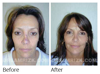 Female face, before and after Eyelids surgery, front view, patient 9