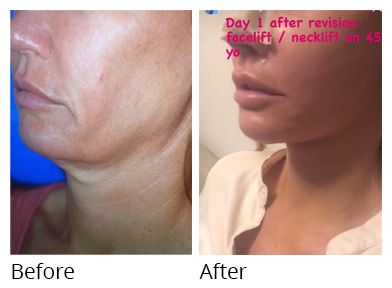 Female face, before and after Facelift and necklift treatment, oblique view, patient 4