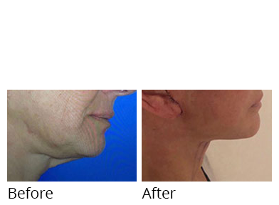 Female face, before and after Facelift and necklift treatment, side view, patient 11