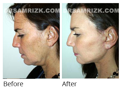 Female face, before and after Facelift and necklift treatment, l-side view, patient 17