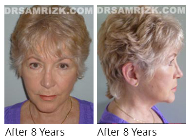 Female face, 8 years after Facelift and necklift treatment, front/side view - patient 18