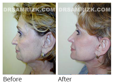 Female face, before and after Facelift and necklift treatment, side view, patient 23