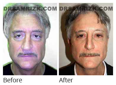 Male face, before and after Facelift and necklift treatment, front view, patient 24