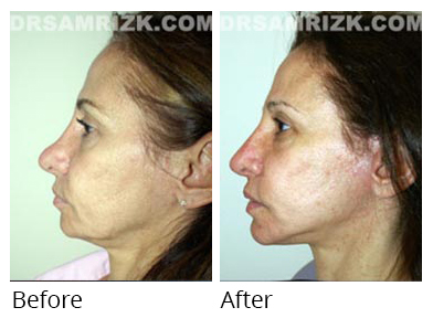 Female face, before and after Facelift and necklift treatment, l-side view, patient 26