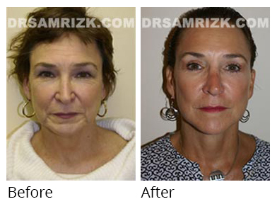 Female face, before and after Facelift and necklift treatment, front view, patient 30