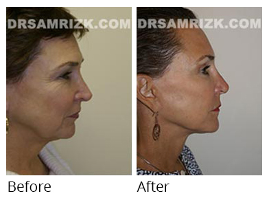 Female face, before and after Facelift and necklift treatment, r-side view, patient 30
