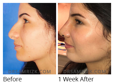Female face, before and 1 week after Rhinoplasty treatment, side view, patient 6