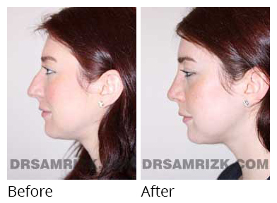 Female face, before and after Rhinoplasty treatment, side view, patient 7