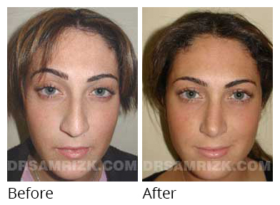 Female face, before and after Rhinoplasty treatment, front view, patient 11