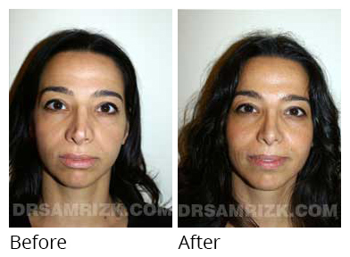 Female face, before and after Rhinoplasty treatment, front view, patient 24