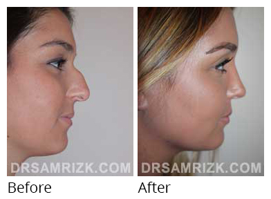 Female face, before and after Rhinoplasty treatment, side view, patient 33