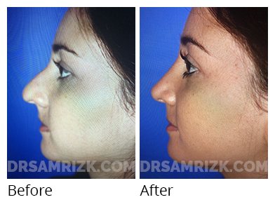 Female face, before and after Rhinoplasty treatment, side view, patient 41