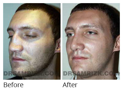 Male face, before and after Rhinoplasty treatment, oblique view - patient 2