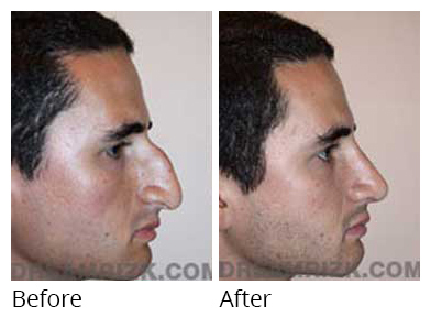 Male face, before and after Rhinoplasty treatment, side view, patient 16