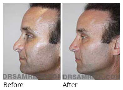 Male face, before and after Rhinoplasty treatment, side view, patient 18