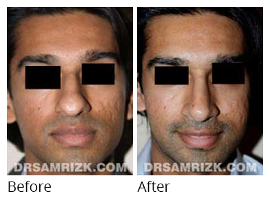 Male face, before and after Rhinoplasty treatment, front view, patient 20