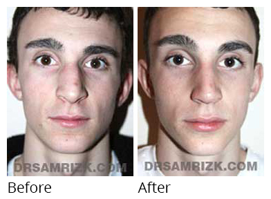 Male face, before and after Rhinoplasty treatment, front view, patient 21