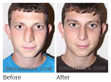 Male face, before and after Rhinoplasty treatment, front view, patient 24