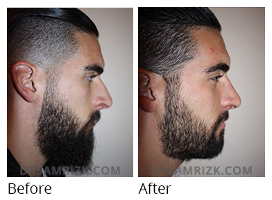 Male face, before and after Rhinoplasty treatment, r-side view, patient 27