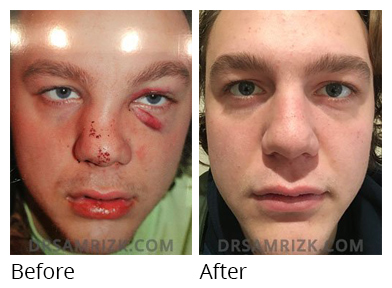 Male face, before and after Rhinoplasty treatment, front view, patient 29