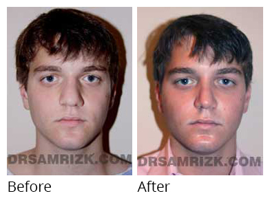 Male face, before and after Rhinoplasty treatment, front view, patient 33