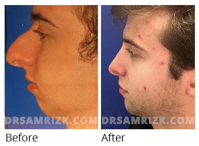 Male face, before and after Rhinoplasty treatment, front view, patient 38