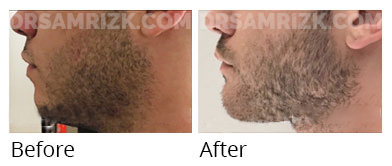 Man's face, before and after Chin and cheek treatment, front view, patient 10